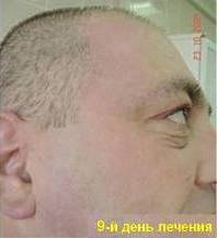 combustio_facies_mini1_resultat.jpg