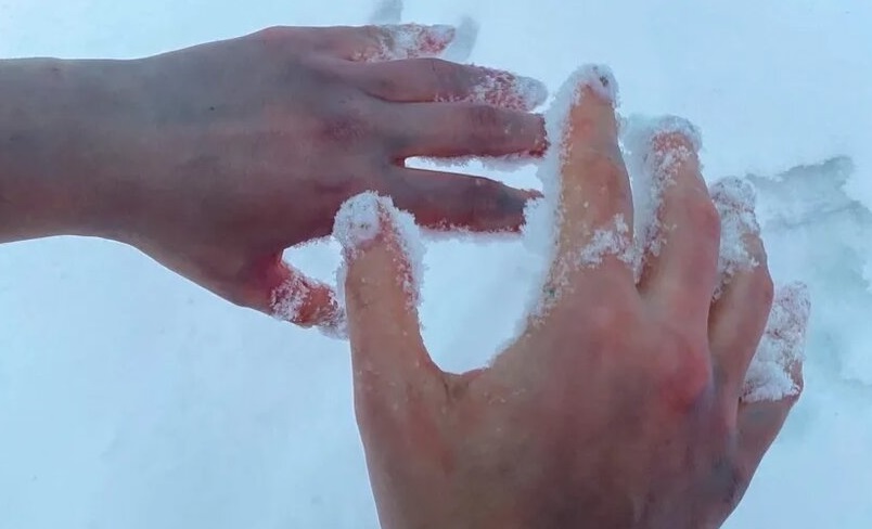 Лечение обморожения в Красноярске